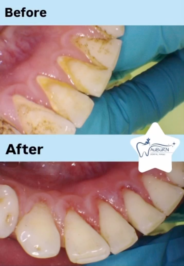 Thorough Plaque and Tartar Removal
