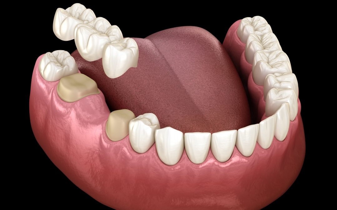 Strengthen Weakened Teeth