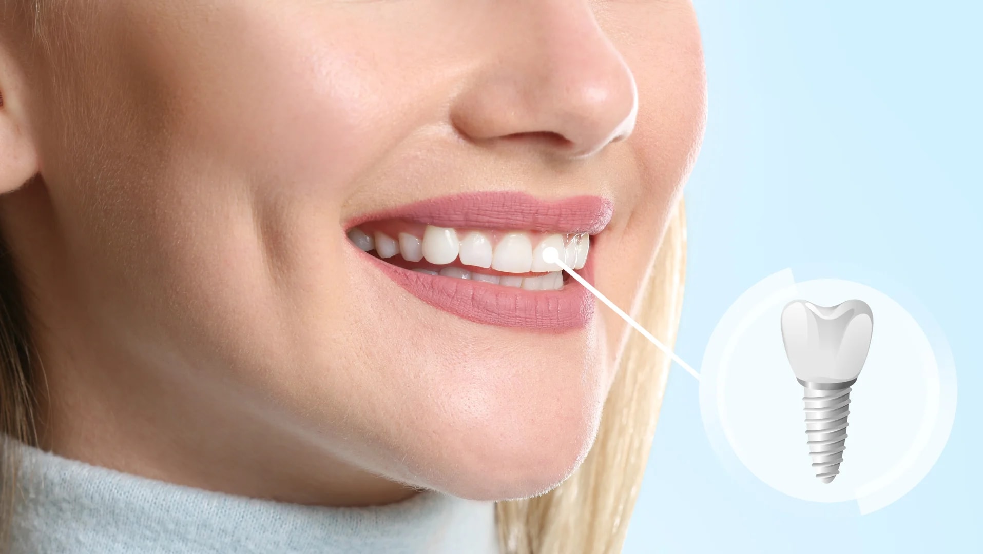 Dental Implants