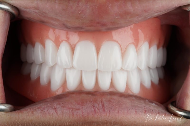Long-Lasting Tooth Replacement